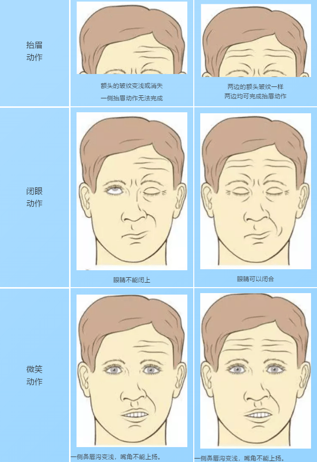 口角歪斜示意图图片