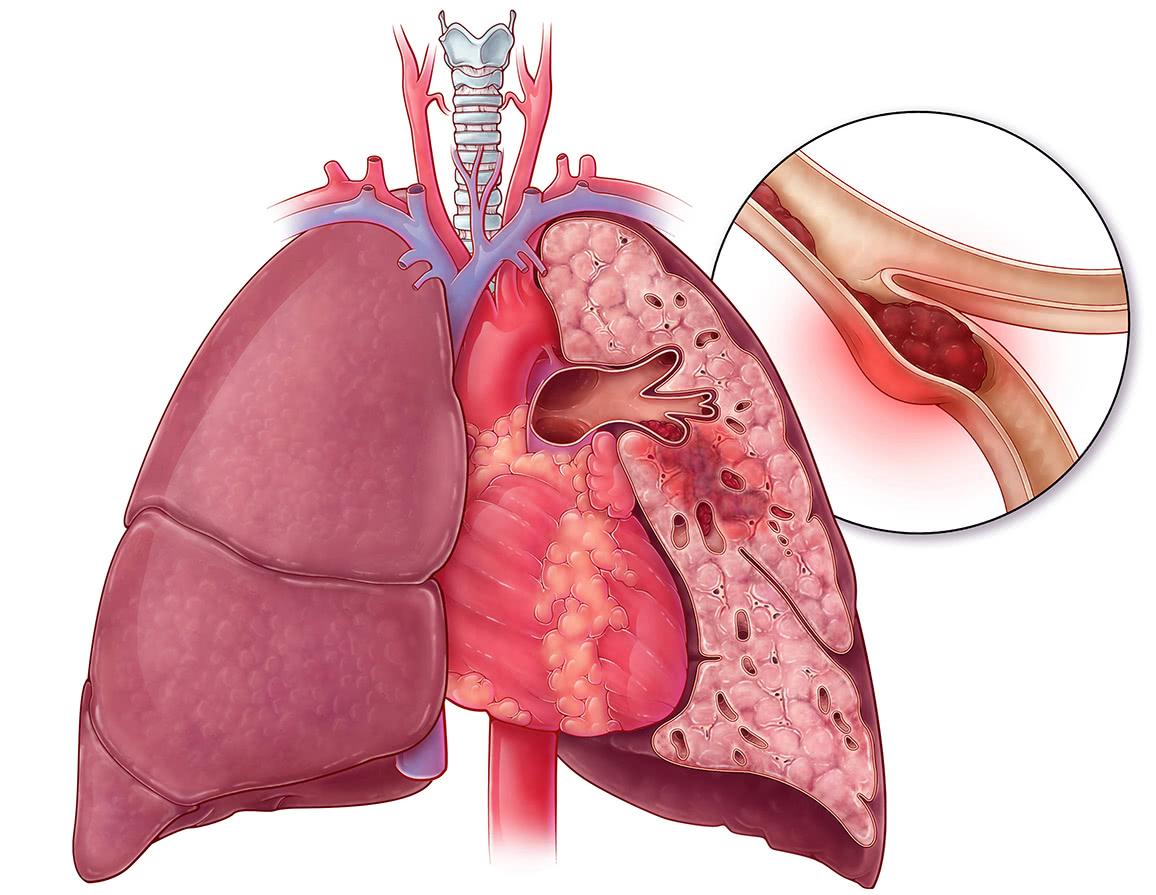 血压低 心跳快 胸闷气短,小心肺血管堵塞,久坐不动是"罪魁"_王星_副主
