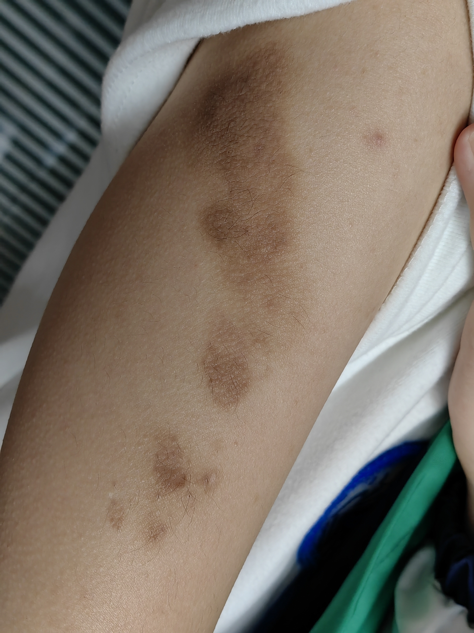 色素性毛表皮痣,长啥样?_朱敏刚_主任医师_爱问健康