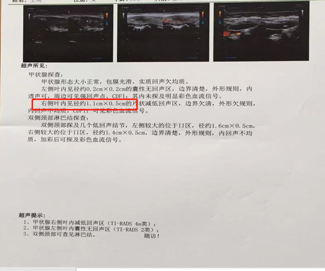 甲状腺结节恶变信号图片