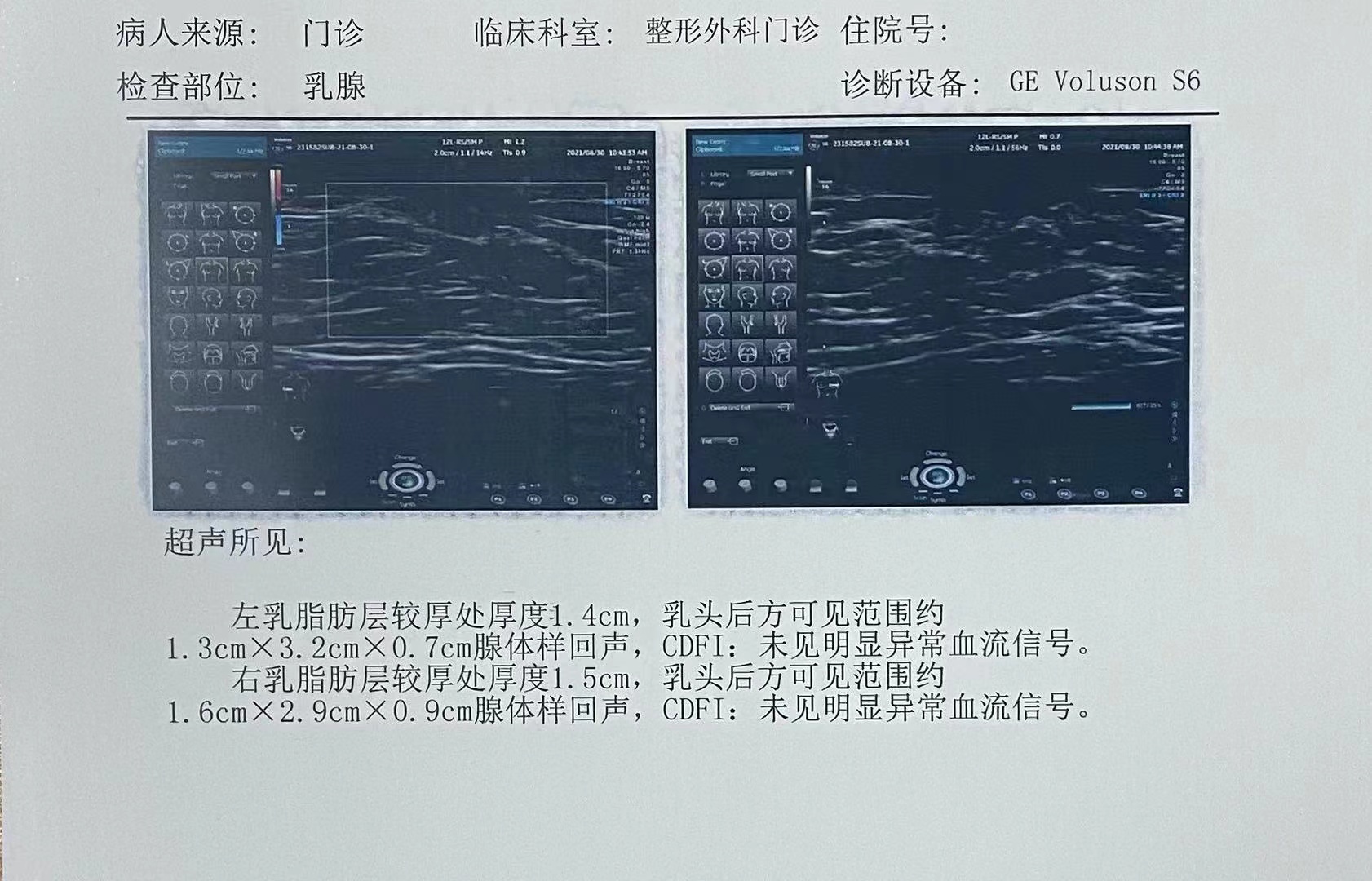 男性乳腺发育超声图片